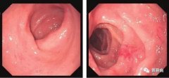 萎縮性胃炎不可怕，只要
