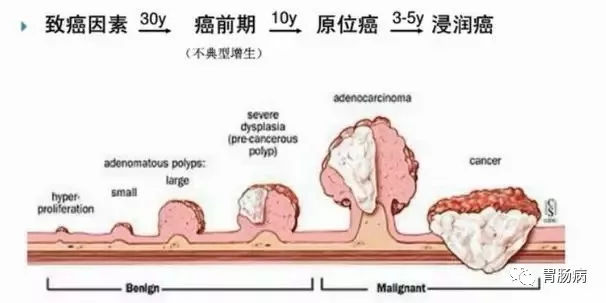 體檢查出腸息肉一定要切除！ 95%腸癌由它演變而來(lái)