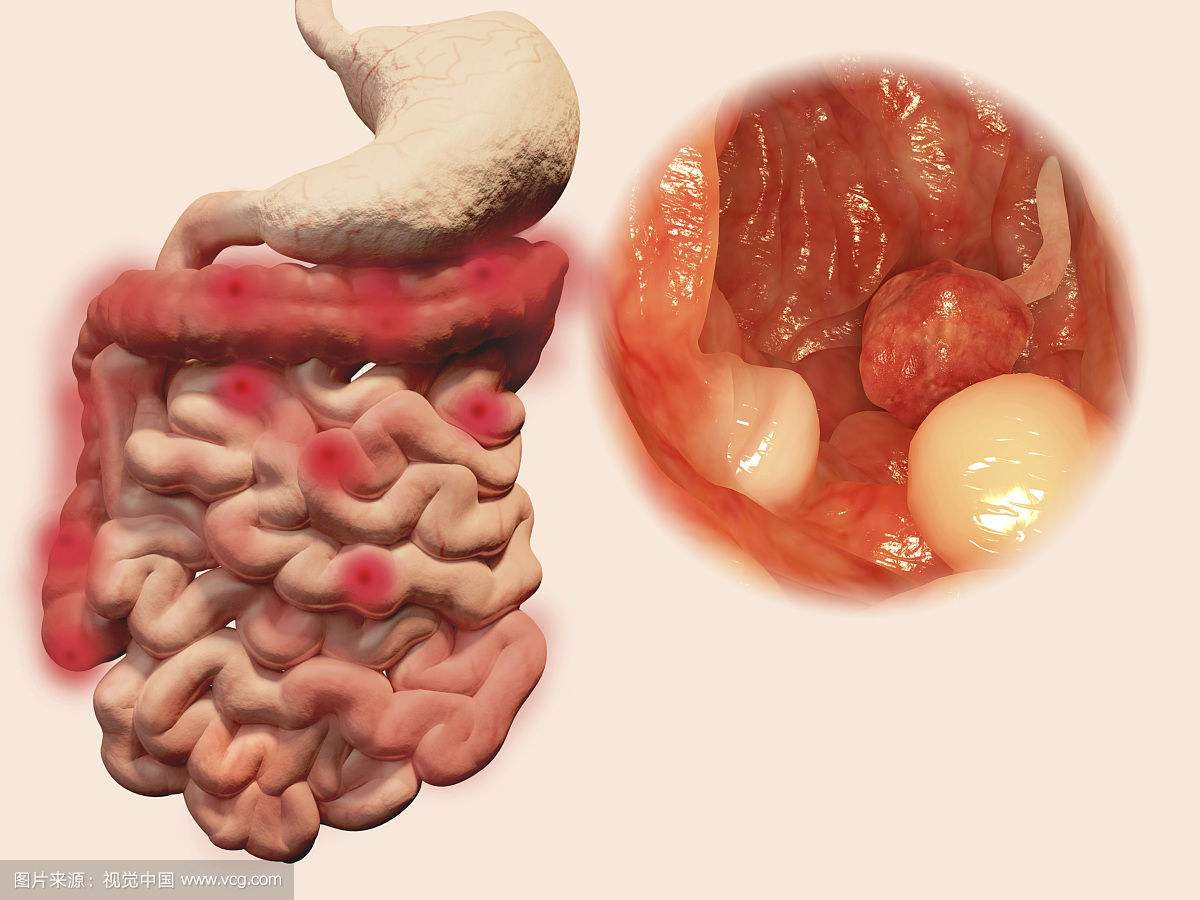 南寧慢性腸炎的費用是多少錢