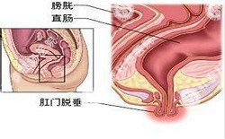 南寧治療脫肛哪家醫(yī)院好？南寧脫肛治療多少錢？